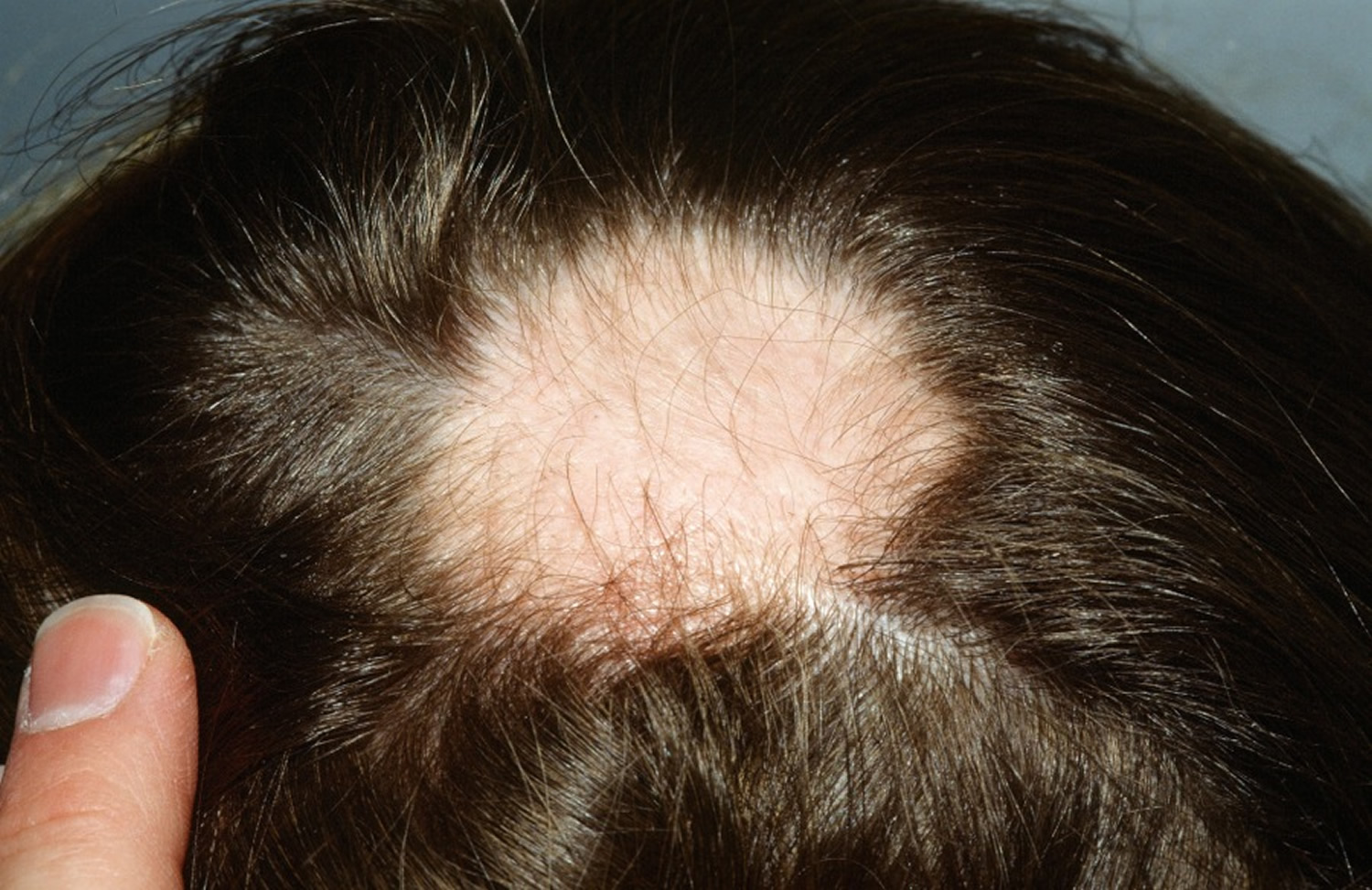 1. Alopecia in Blue Dobermans - wide 5