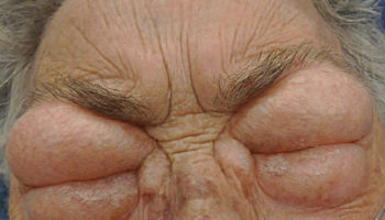 angioedema