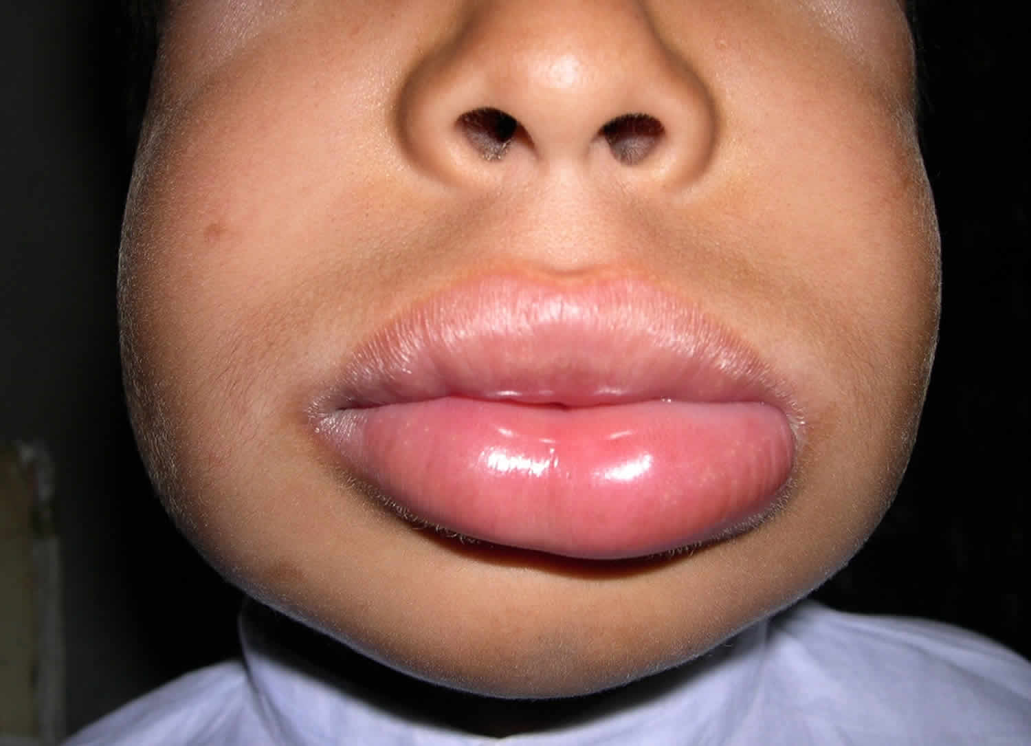 angioedema lips