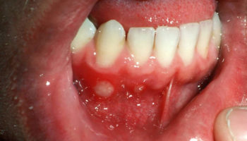 aphthous_ulcer