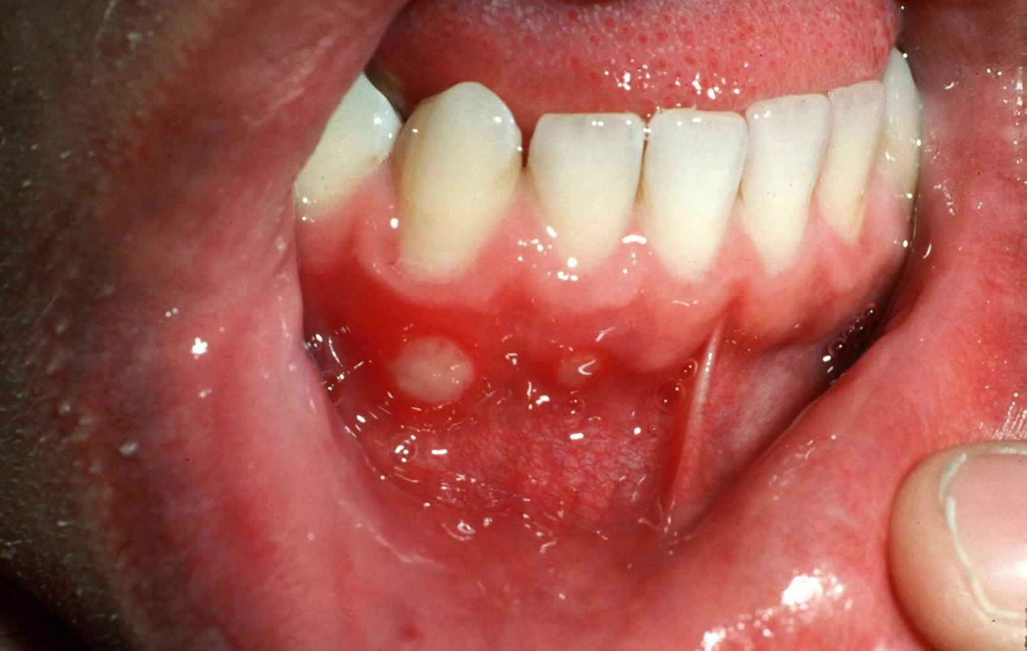 aphthous stomatitis tongue