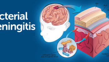 bacterial meningitis