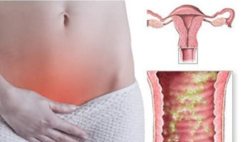 bacterial vaginosis