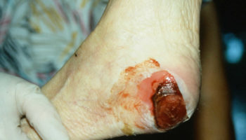 bed sores