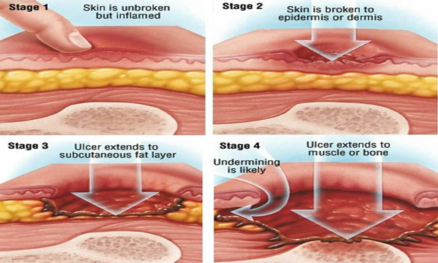 pressure-sores