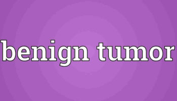 benign tumor