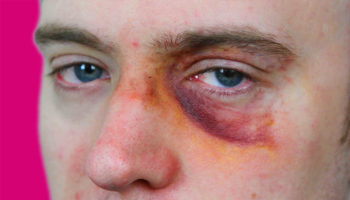 black eye