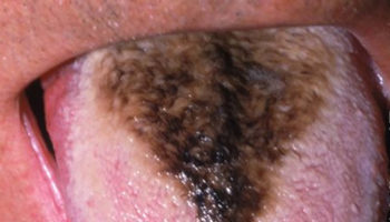black hairy tongue