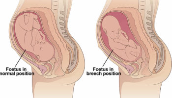 breech baby