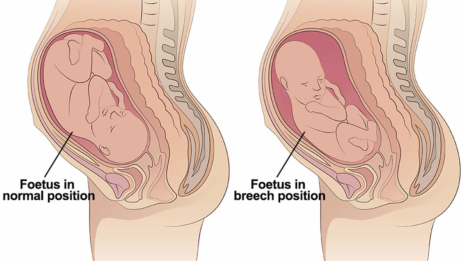 breech presentation