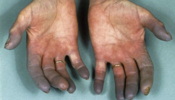 Buerger’s disease