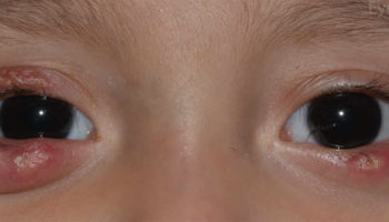 chalazion-eye