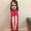 cleidocranial dysplasia