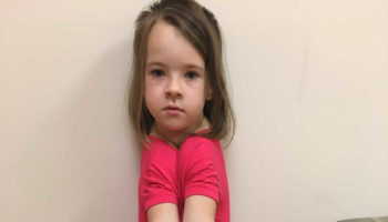 cleidocranial dysplasia