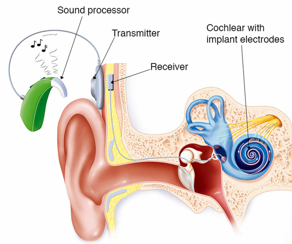 Cochlear Implant Function Surgery And Cochlear Implant Pros And Cons