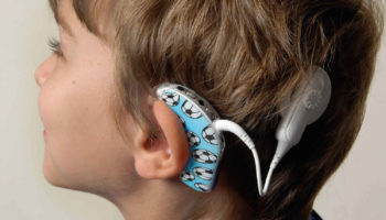 cochlear implant