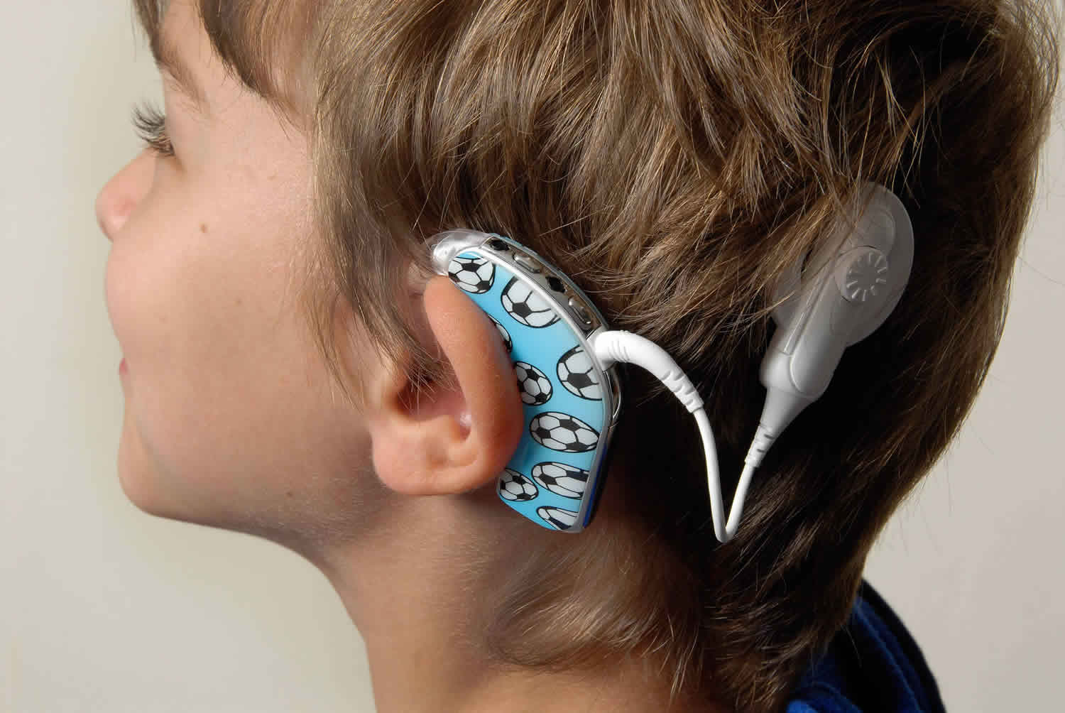 Cpt Code For Cochlear Implant Removal