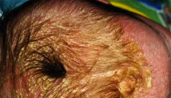 cradle cap