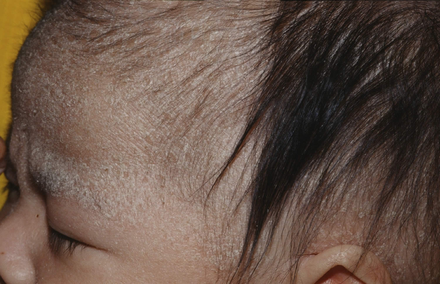 cradle cap baby