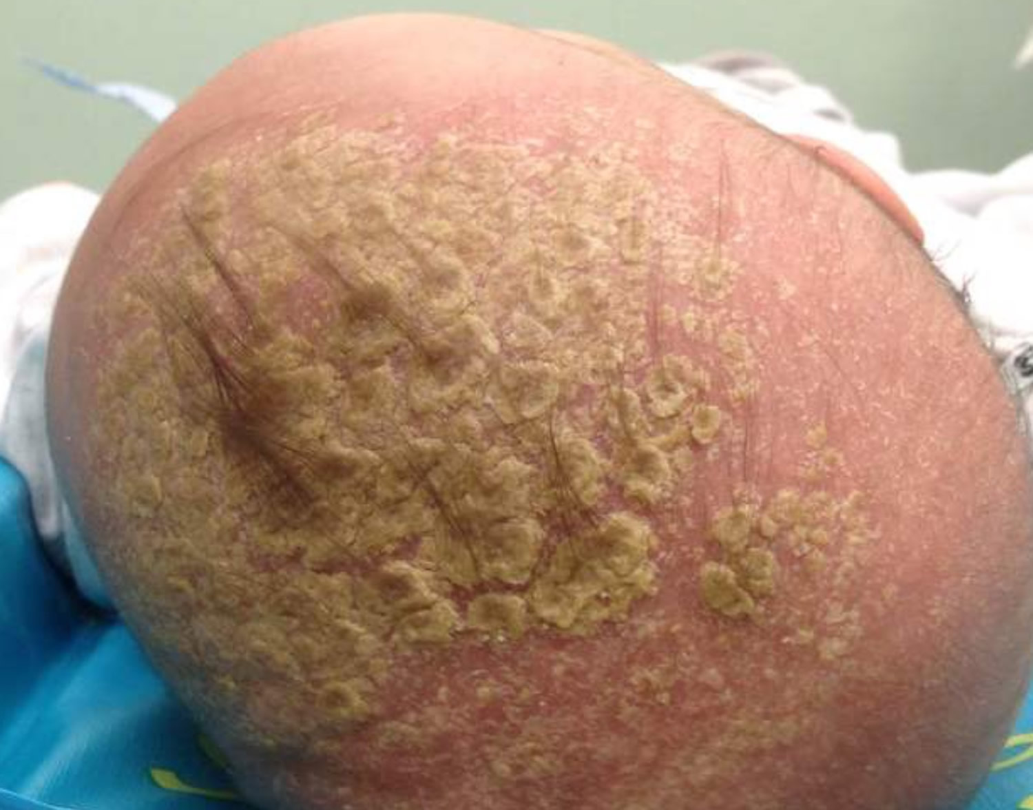 Cradle cap baby scalp