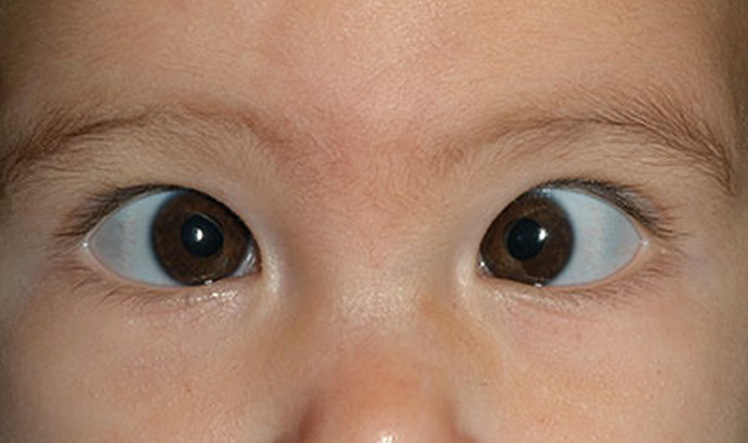 Почему у ребенка голубые глаза. Содружественное сходящееся альтернирующее косоглазие. Сходящееся содружественное альтернирующее косоглазие у детей. Альтернирующее косоглазие у ребенка. Монолатеральное косоглазие.
