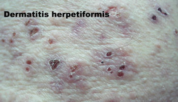 dermatitis herpetiformis