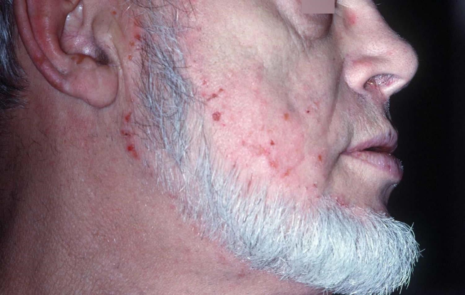 Dermatitis herpetiformis face