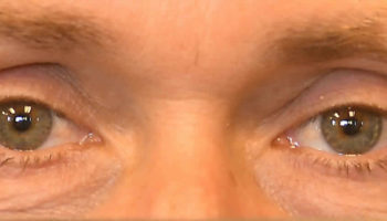 diabetic retinopathy