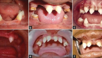 ectodermal dysplasia