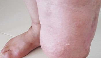 elephantiasis