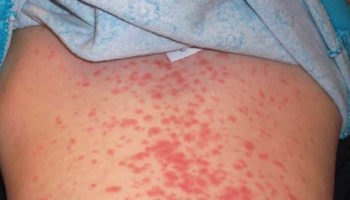 epstein barr virus infection
