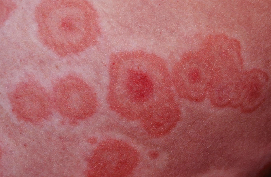 Erythema multiforme causes, types, symptoms, diagnosis and treatment