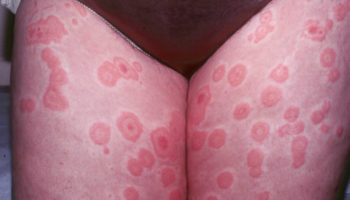 erythema multiforme