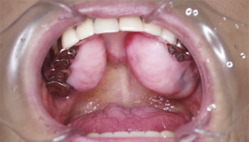 exostosis