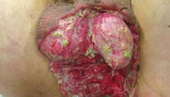 fournier’s gangrene