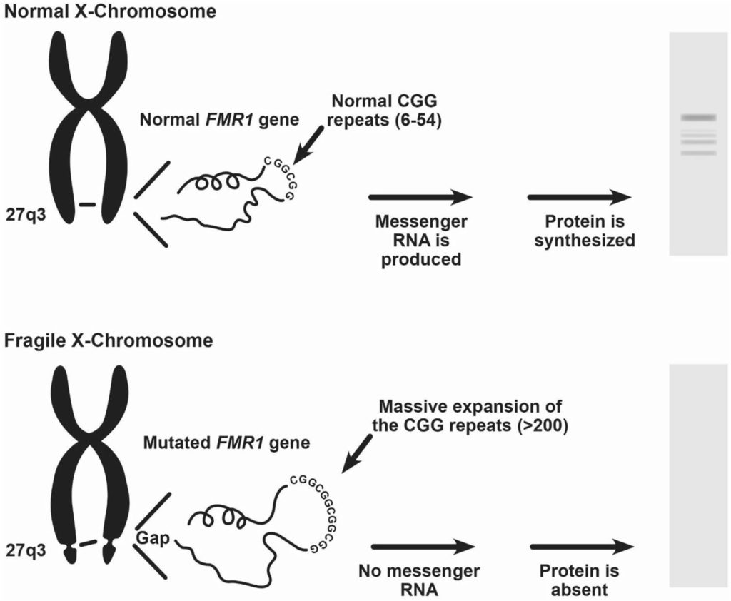 Fragile x syndrome что это