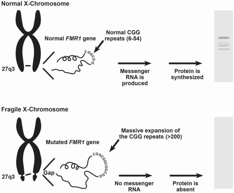 fragile-x-syndrome-causes-inheritance-symptoms-diagnosis-treatment