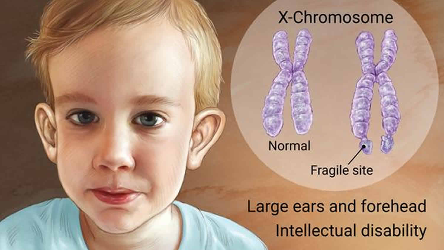 fragile x syndrome karyotype