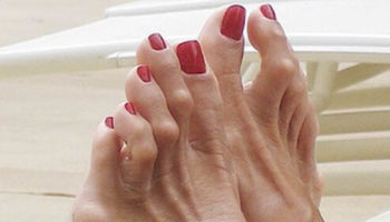 hammer toe