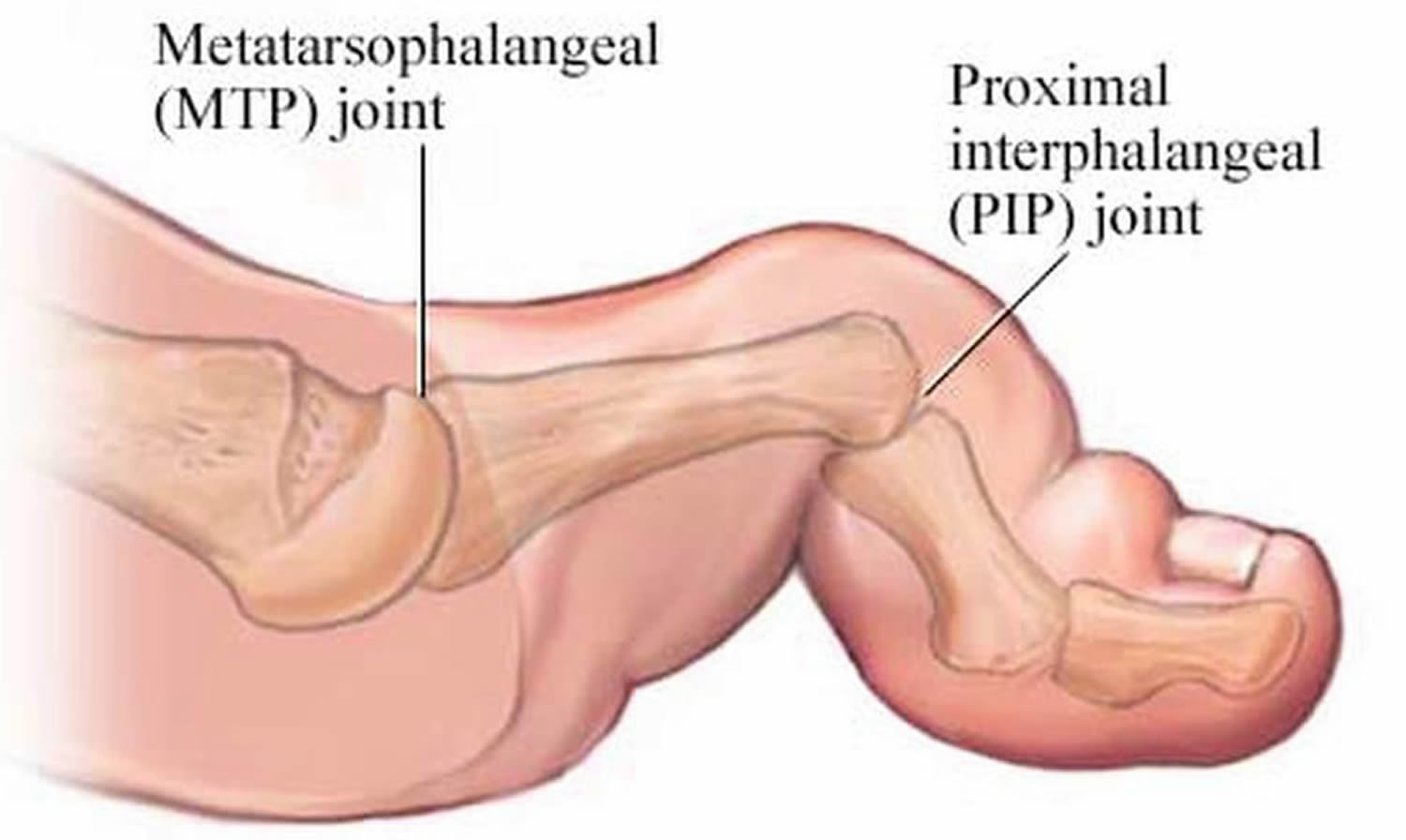 Hammer Toe Causes Appearance Symptoms And Hammer Toe Treatment