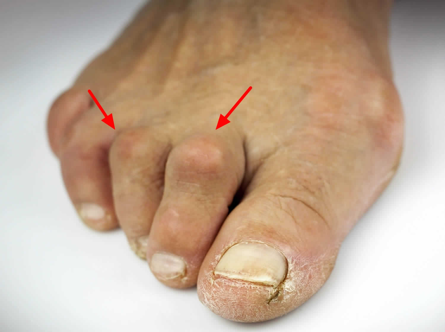 Hammer toe causes, appearance, symptoms and hammer toe treatment