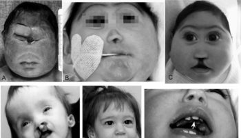 holoprosencephaly
