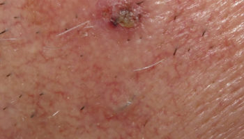ingrown hair