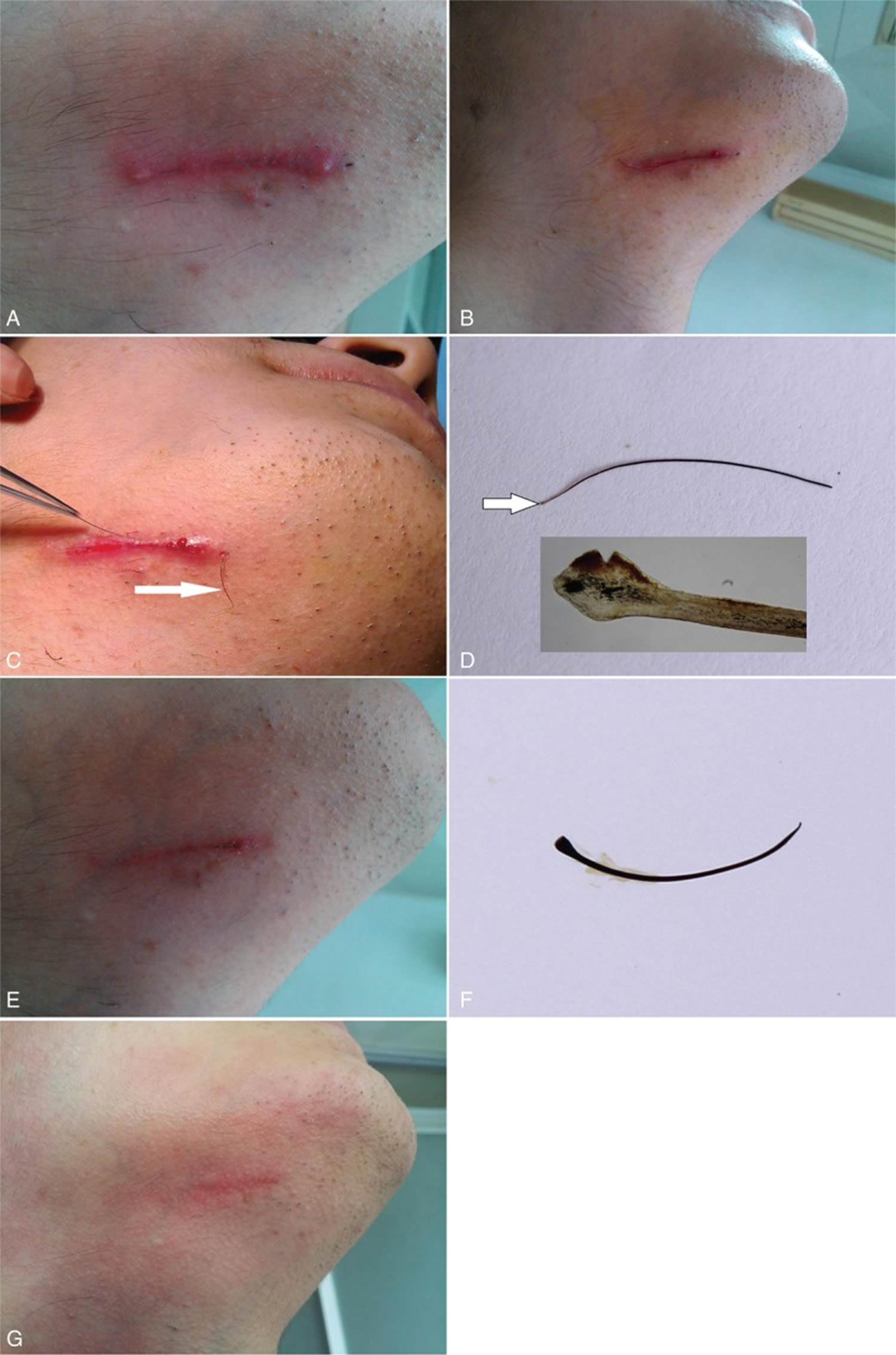 does-an-ingrown-hair-cause-a-swollen-lymph-node-lipstutorial