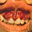 kaposi sarcoma