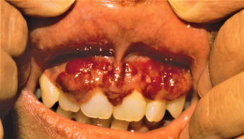 kaposi sarcoma