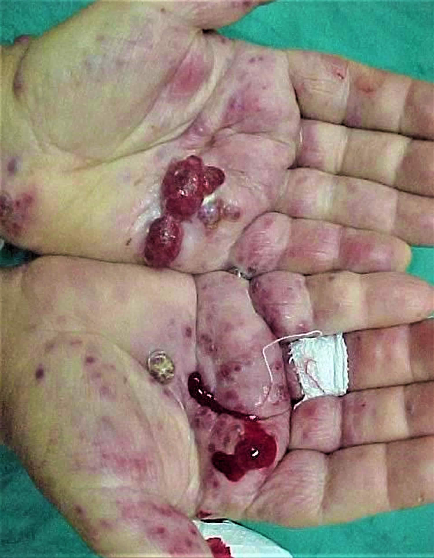 Kaposi sarcoma hands