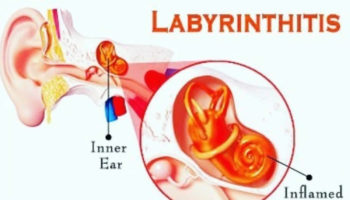 labyrinthitis