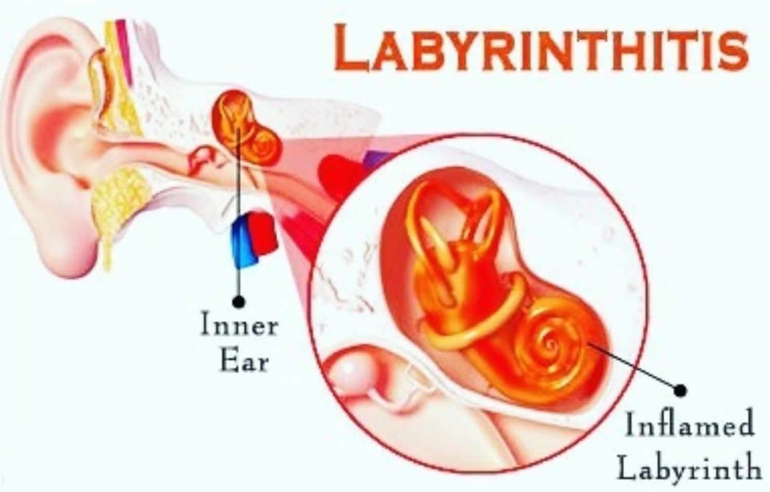 labyrinthitis-causes-symptoms-prognosis-diagnosis-exercise-treatment