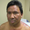 leprosy 3